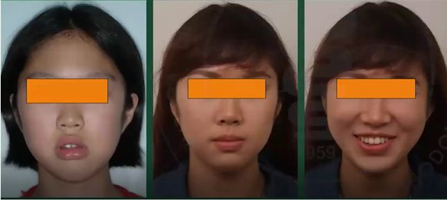 Bệnh nhân trước và sau điều trị